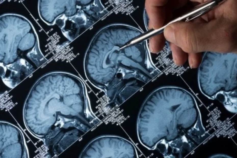 alzheimer mersul încetinește declinul