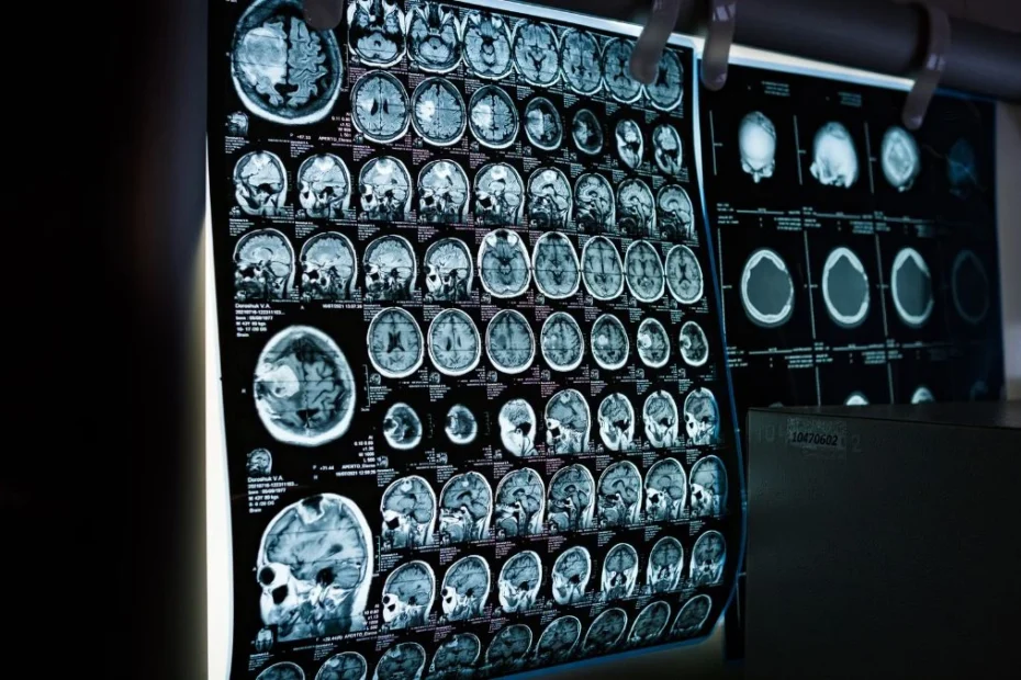 creierul înghețat a prins viață Foto: tomografie computerizată a creierului