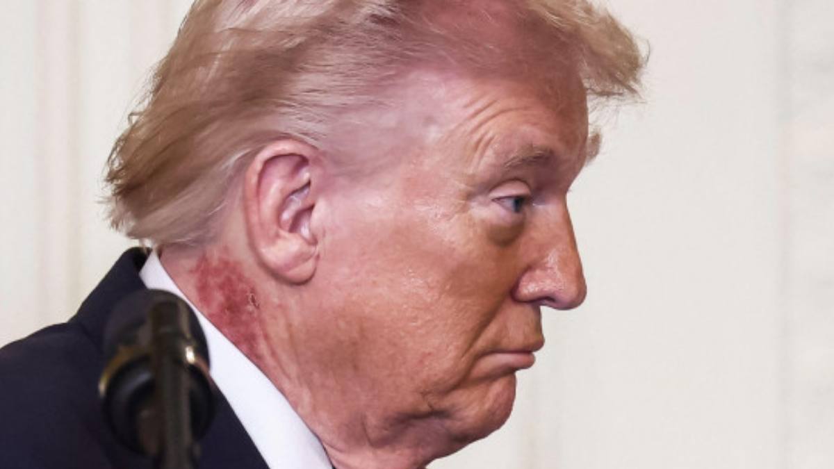 Pata roșie de pe gâtul lui Trump